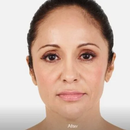 Client's skin before and after treatment at Lift & Revive