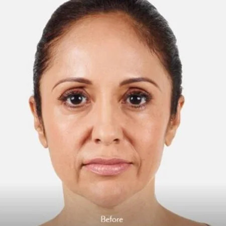Client's skin before and after treatment at Lift & Revive